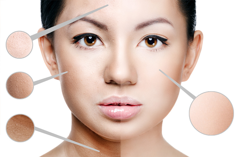 chemical peel course