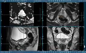 Imaging for Low-Grade Prostate Cancer