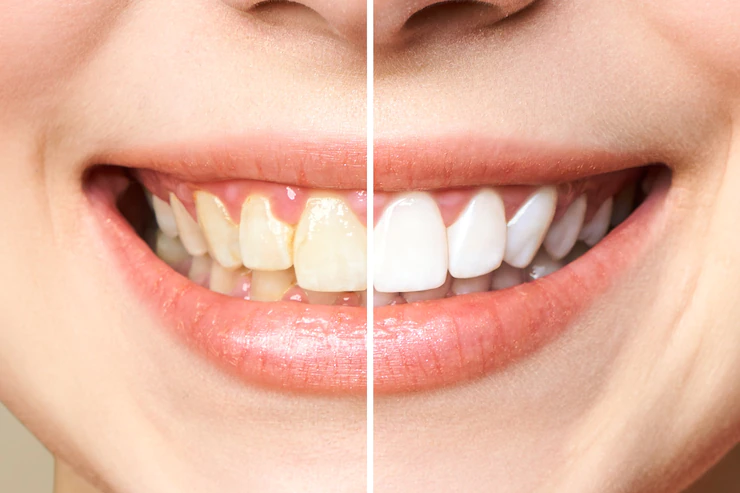 Teeth Whitening tomball tx